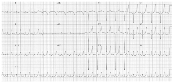 ECG: peaked T waves 